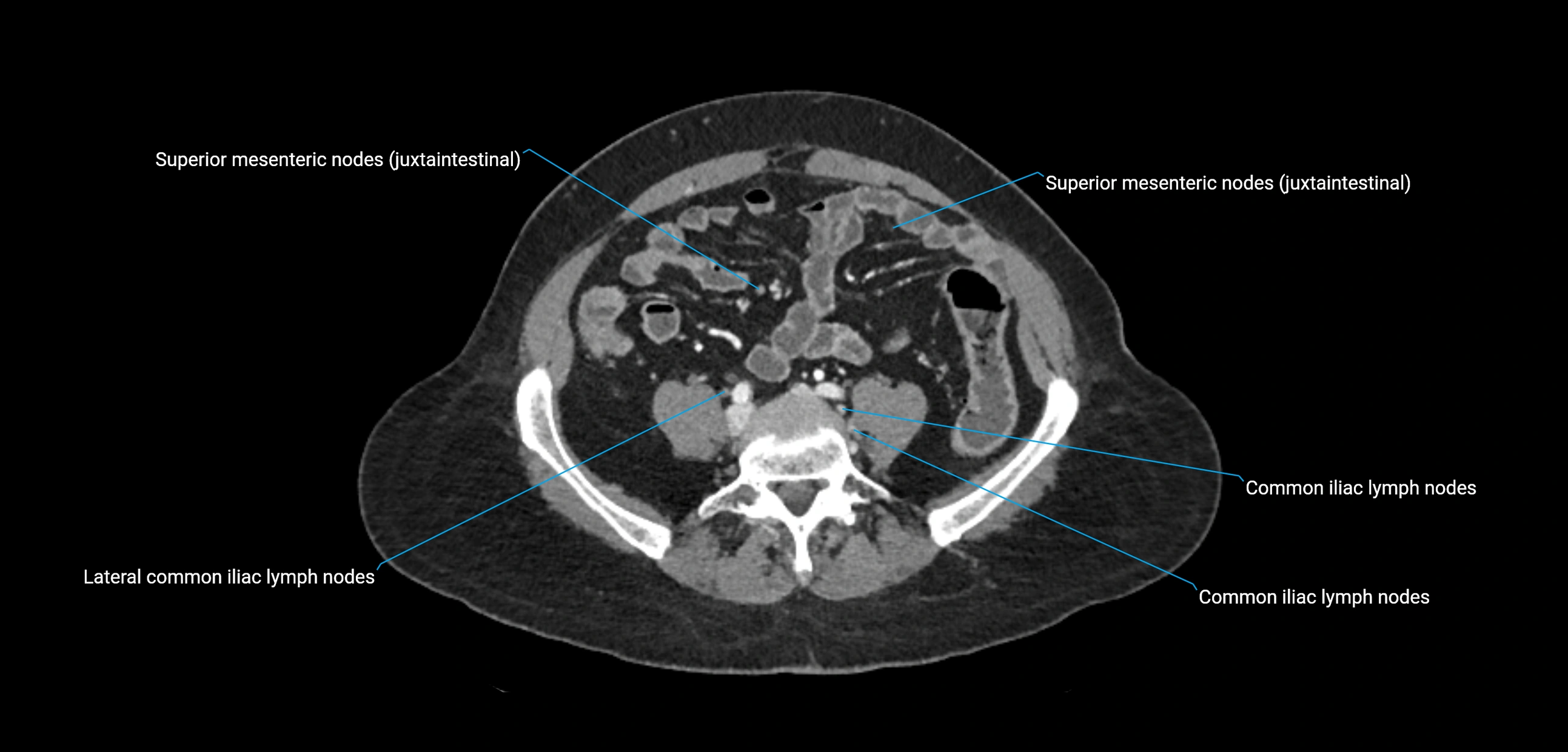 CT ct abdominal lymph nodes  axial cross sectional anatomy  enchanced radiology image -img-00002-00294.webp